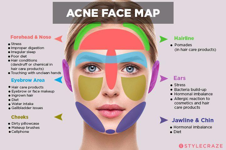 Acne-face-map-720x480.jpg